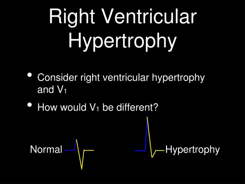 Deciphering Right Ventricular Hypertrophy: Understanding the Medical Terminology