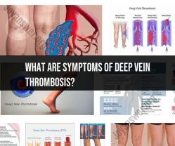 Deep Vein Thrombosis (DVT) Symptoms: Recognizing the Warning Signs