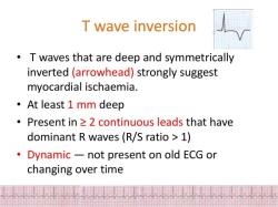 Detecting Ischemia with EKG: Insights into Cardiac Monitoring