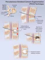 Diagnosing Compression Fractures: Methods and Procedures