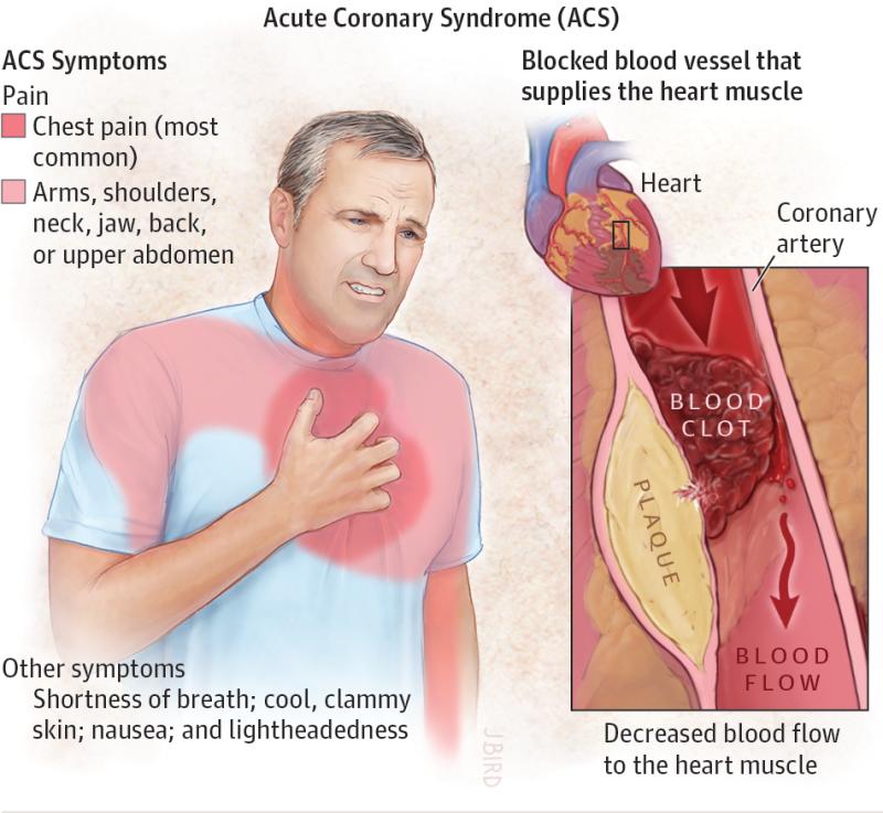 Early Signs and Symptoms of Myocardial Infarction: Recognizing Warning Indicators