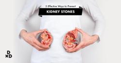 Eliminating Kidney Stones from the Bladder: Prevention and Treatment