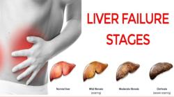 End-Stage Liver Disease: Prognosis and Timeline