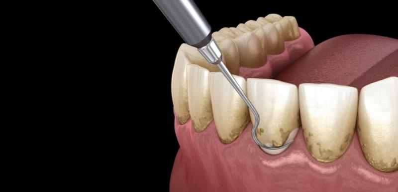 Enhancing Dental Implant Long-Term Control: The Impact of Periodontal Maintenance Care