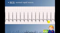 Factors Leading to Abnormal EKG Results: A Comprehensive Guide