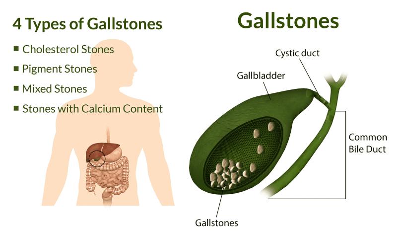 Flushing Out Your Gallbladder: Methods and Considerations