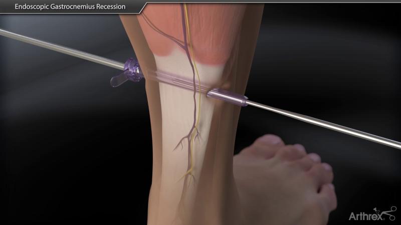 Gastrocnemius Recession: Surgical Procedure Overview