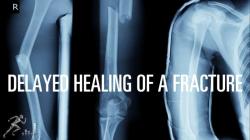 Healing a Compression Fracture: Natural Recovery and Treatment