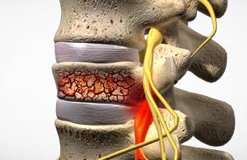 Healing Stress Fractures in the Spine: What You Need to Know