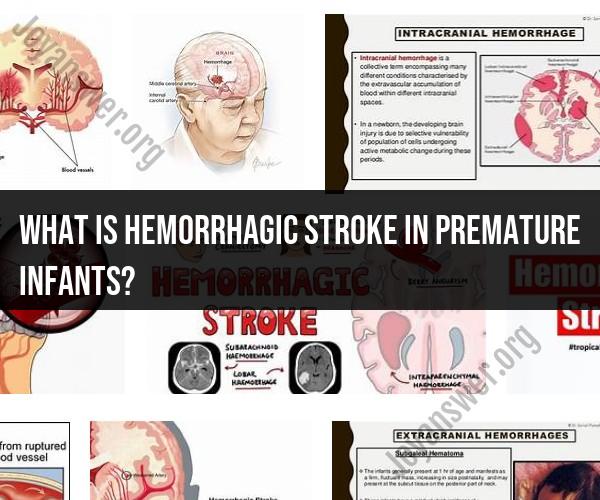 Hemorrhagic Stroke in Premature Infants: Causes and Implications