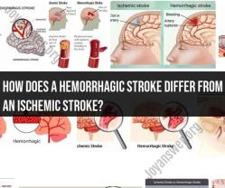 Hemorrhagic Stroke vs. Ischemic Stroke: Key Differences