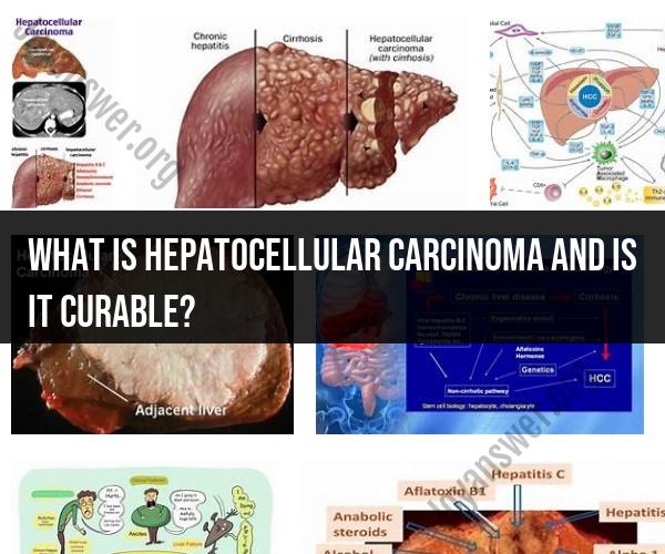 Hepatocellular Carcinoma: Understanding a Liver Cancer and Its Curability