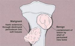 How Are Benign Tumors in Humans Treated or Cured?