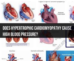 Hypertrophic Cardiomyopathy and Blood Pressure: Understanding the Link