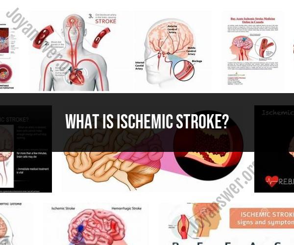 Ischemic Stroke: Understanding Causes, Symptoms, and Treatment