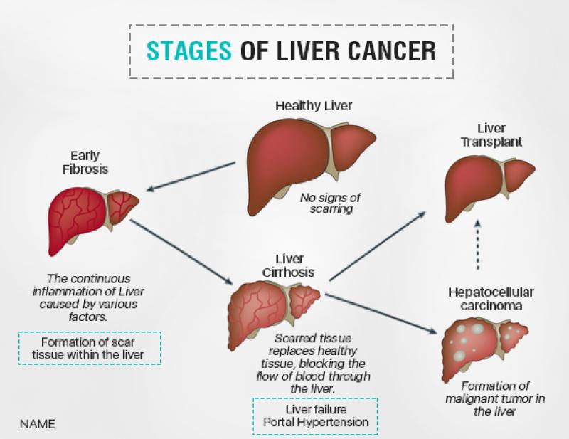 Liver Cancer Symptoms: What Are the Common Symptoms of Liver Cancer?