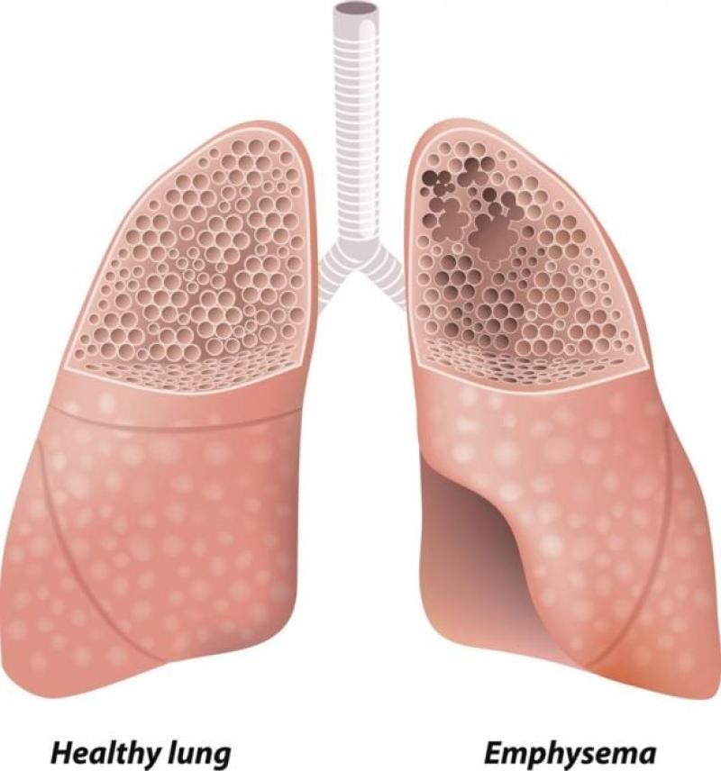 Managing Emphysema: Treatment Approaches for Each Stage