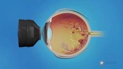 Managing Macular Edema: Treatment Options