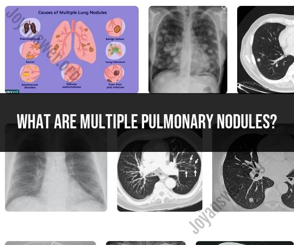 Multiple Pulmonary Nodules: Understanding and Evaluation