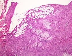 Myxoid Mysteries: Decoding Myxoid Soft Tissue Tumors