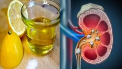 Natural Methods to Dissolve Kidney or Bladder Stones