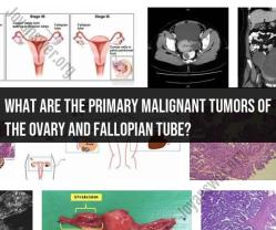 Primary Malignant Tumors of the Ovary and Fallopian Tube: Types and Characteristics