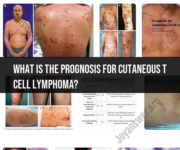 Prognosis for Cutaneous T Cell Lymphoma: Medical Outlook