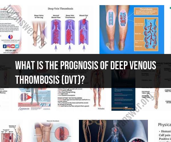 Prognosis of Deep Venous Thrombosis (DVT): Understanding Potential Outcomes