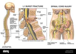 The Impact of Compression Fractures on the Spine: A Comprehensive Overview