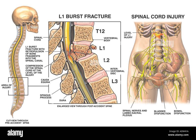 The Impact of Compression Fractures on the Spine: A Comprehensive Overview