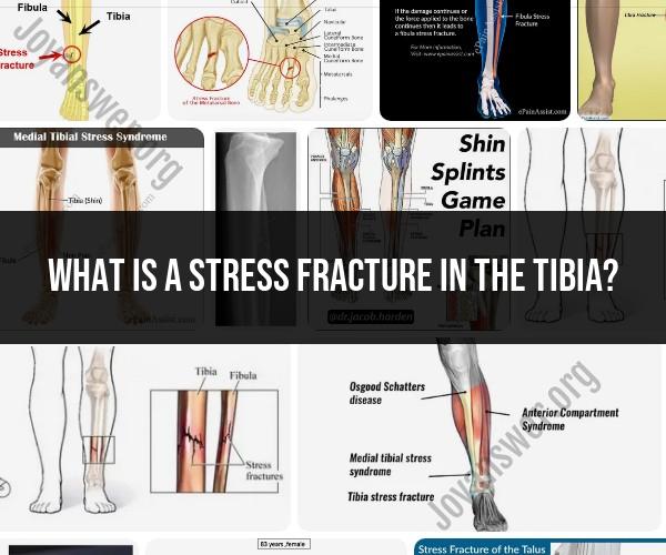 Tibial Stress Fracture: Causes and Treatment