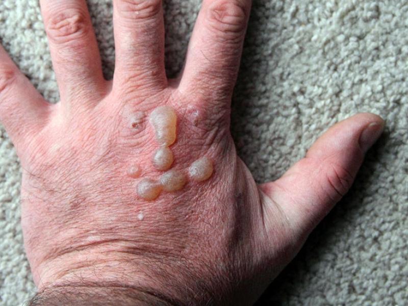 Tiny Itchy Blisters on Hands: Causes and Remedies