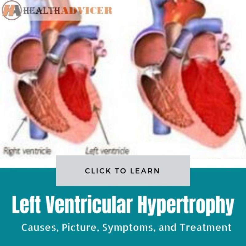 Treatment Options for Left Ventricular Hypertrophy: Insights and Approaches