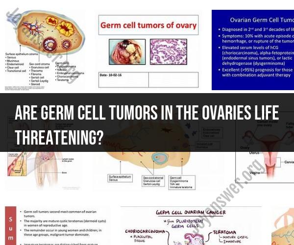 Understanding Germ Cell Tumors in the Ovaries: Assessing Life Threat Level