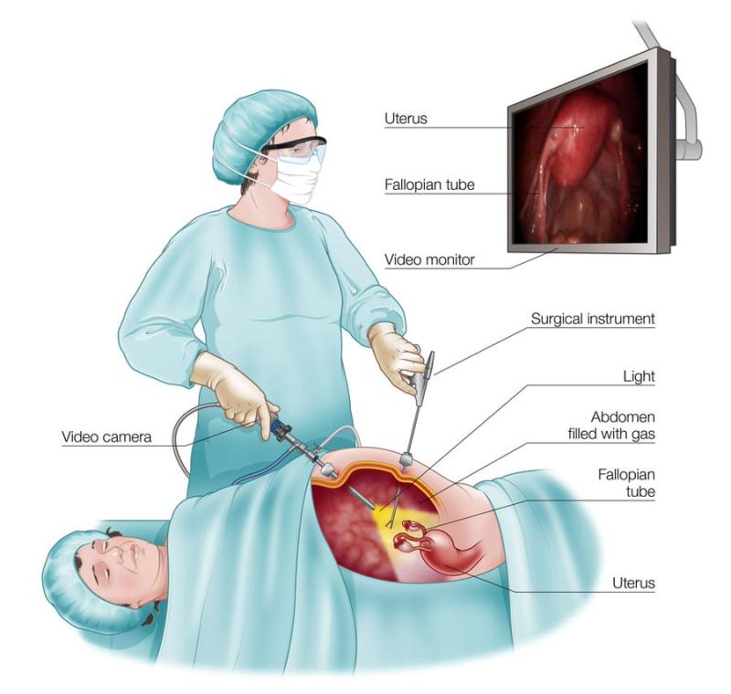 Understanding Laparoscopic Surgery Costs: What to Expect