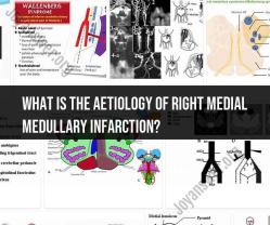 Unraveling the Aetiology of Right Medial Medullary Infarction
