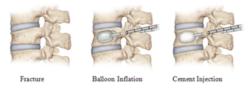 Vertebral Compression Fracture Severity: Assessing the Impact