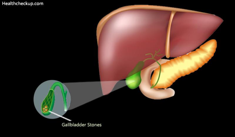 Achieving the Most Effective Gallbladder Flush