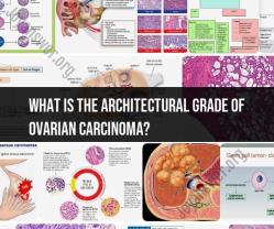 Architectural Grade of Ovarian Carcinoma: Understanding Tumor Staging