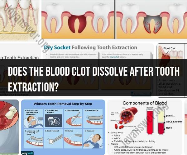 Blood Clot Dissolution After Tooth Extraction: What to Expect