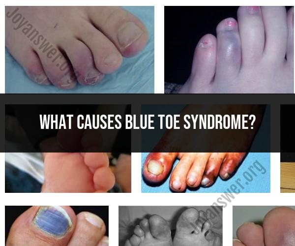 Blue Toe Syndrome Causes and Symptoms: An Overview