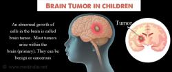 Can Benign Brain Tumors Return After Treatment?