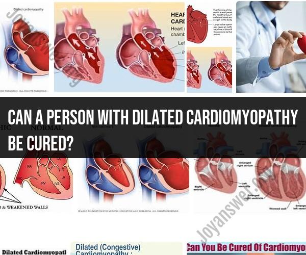 Can Dilated Cardiomyopathy Be Cured? Insights into the Condition