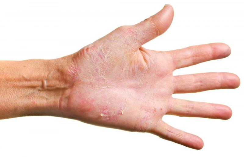Causes of Blisters on Hands: Exploring Triggers