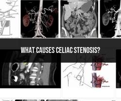 Causes of Celiac Stenosis: Understanding the Condition's Origins
