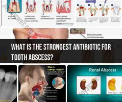 Choosing the Right Antibiotic for Tooth Abscess: A Guide