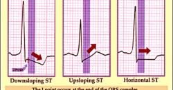 Common Causes of an Abnormal ECG: Understanding Variations
