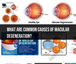 Common Causes of Macular Degeneration: Understanding the Disease
